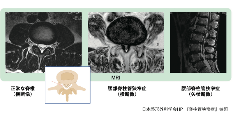 脊柱管狭窄症のMRI所見