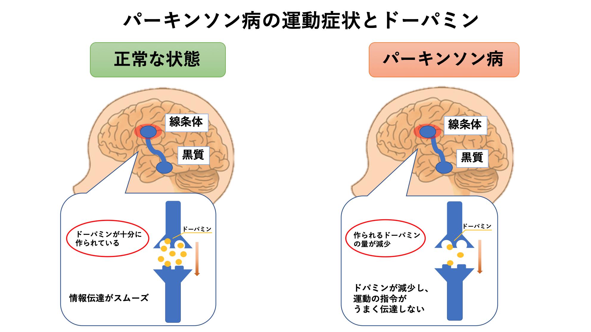 パーキンソン病とドーパミン