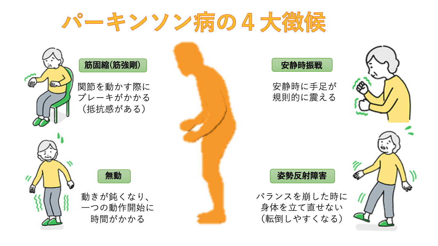 パーキンソン病と四大徴候