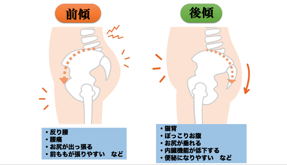 骨盤の前傾・後傾