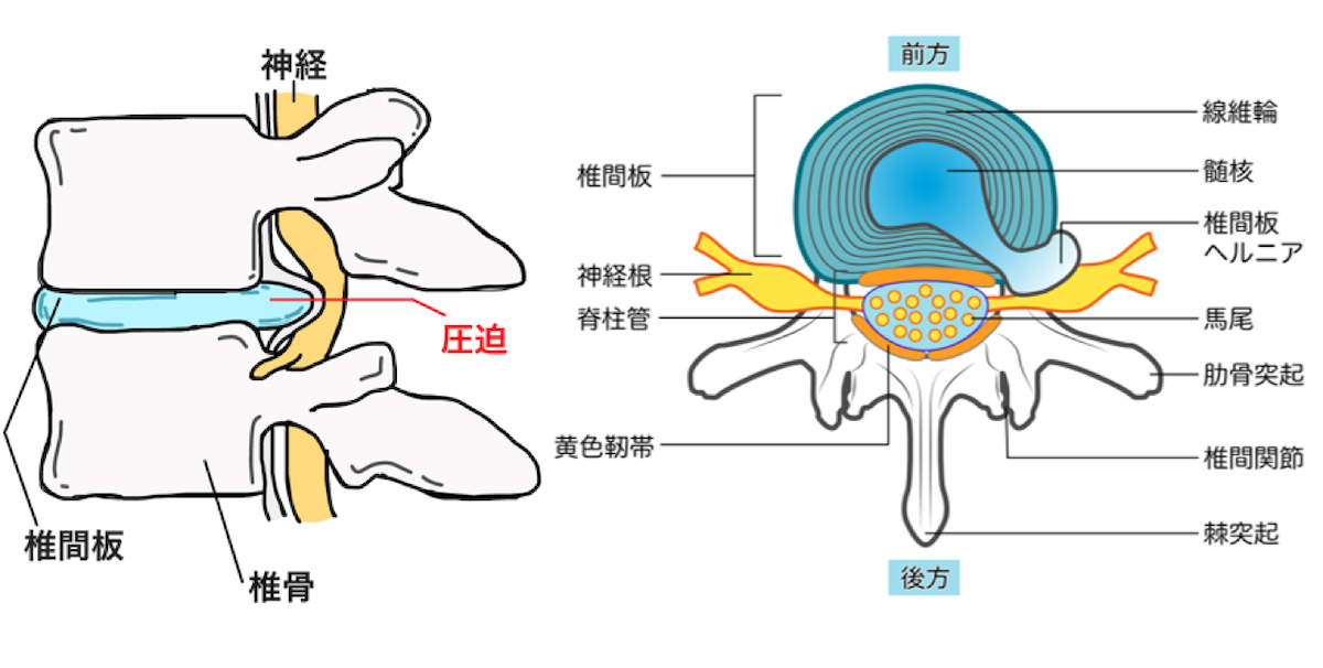 腰椎椎間板ヘルニアリハビリ｜T-performance