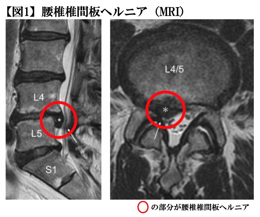 腰椎椎間板ヘルニアの分類｜T-performance