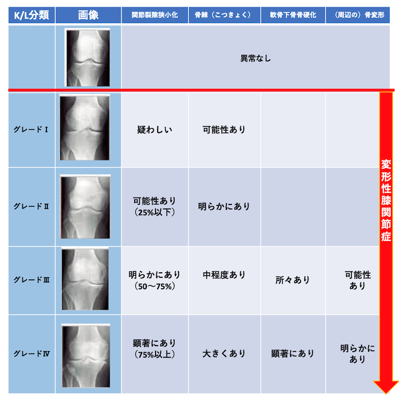 変形性膝関節症の分類｜T-performance