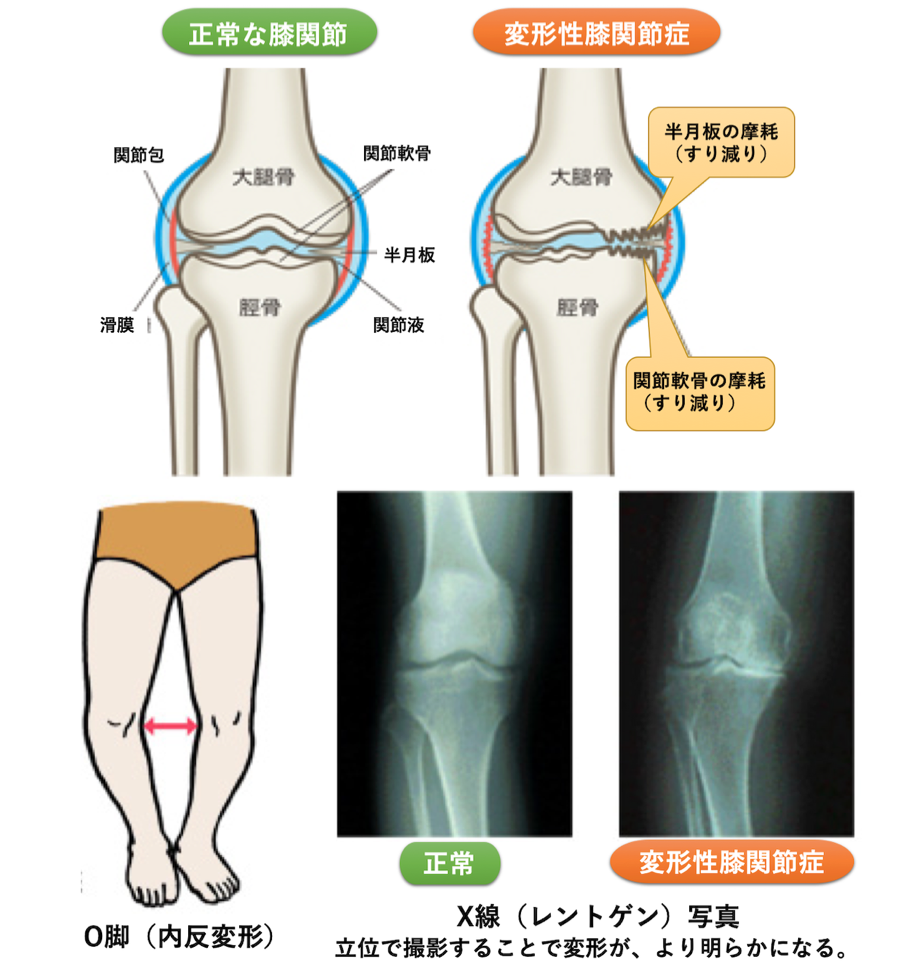 変形性膝関節症｜T-performance