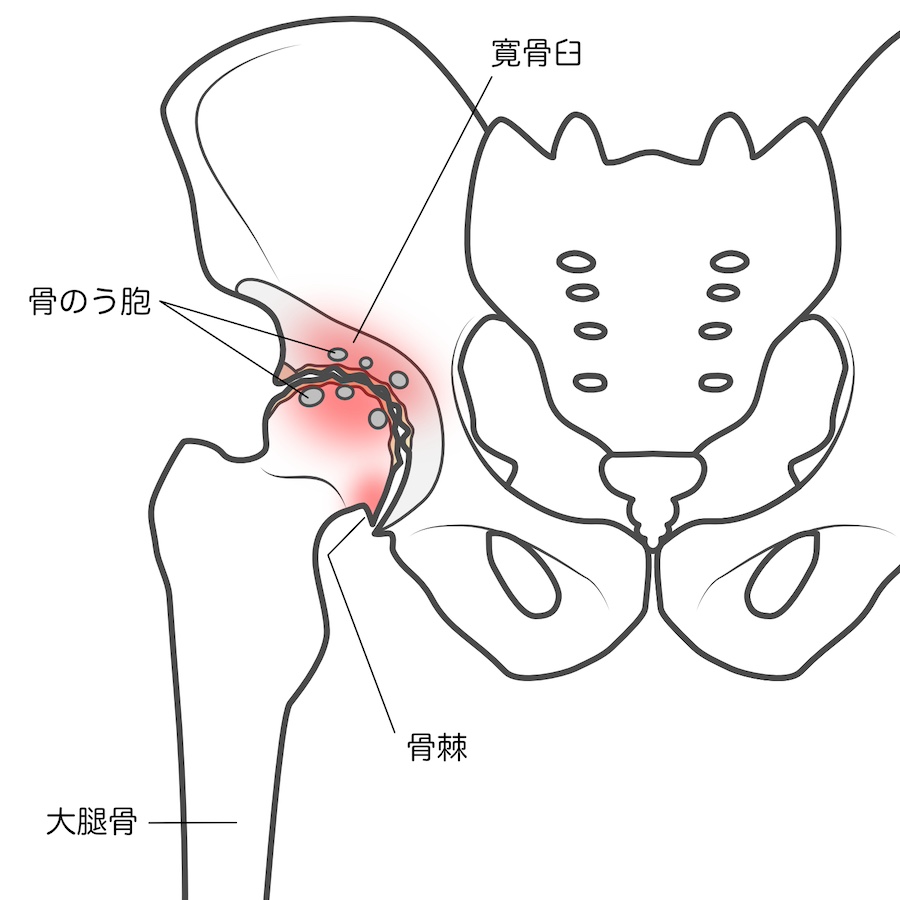 変形性股関節症｜T-performance
