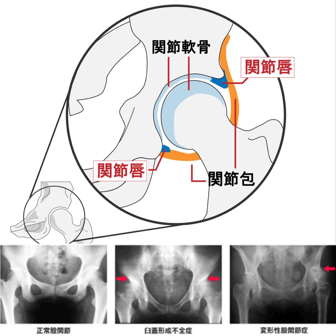 変形性股関節症の分類｜T-performance