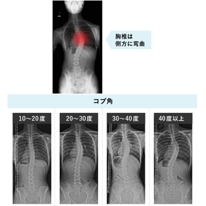 側弯症の分類｜T-performance
